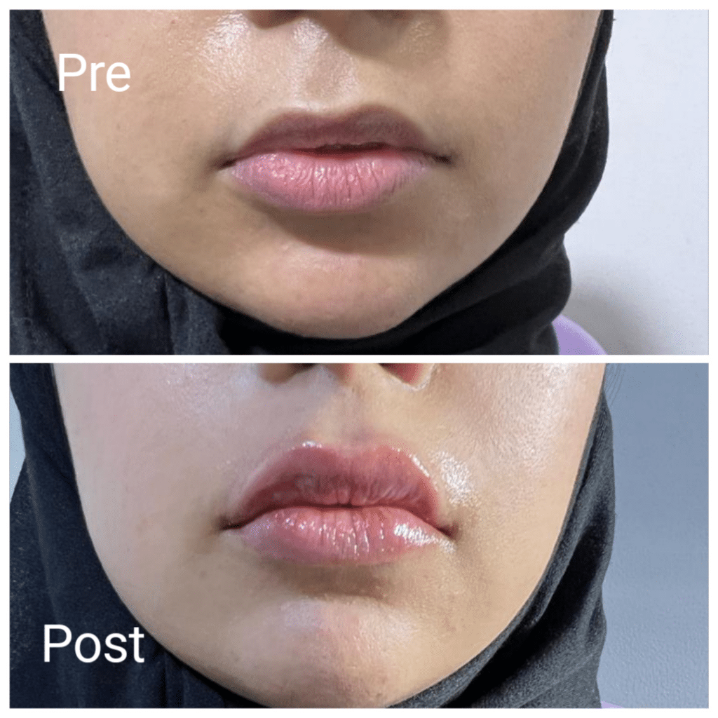 Before and after lip augmentation